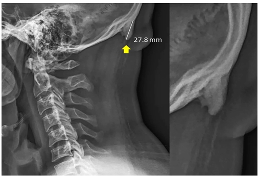 Researchers at the University of the Sunshine Coast in Queensland, Australia, have documented the prevalence of bone spurs at the bace of the skull among young adults. (사진=SCIENTIFIC REPORTS)